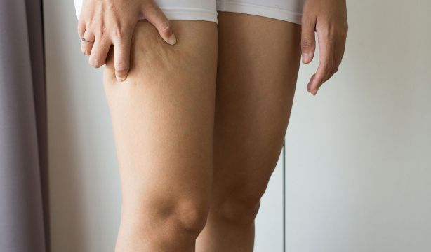 Lipedema: la enfermedad que limita la vida de miles de mujeres y que sí tiene tratamiento
