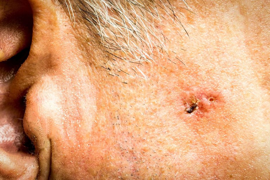 Carcinoma de células basales en el rostro de un sénior. (Bigstock) Carcinoma de células basales en el rostro de un sénior. (Bigstock)