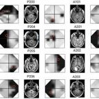 Imágenes obtenidas en el estudio de estimulación cerebral e ictus. (Bigstock)