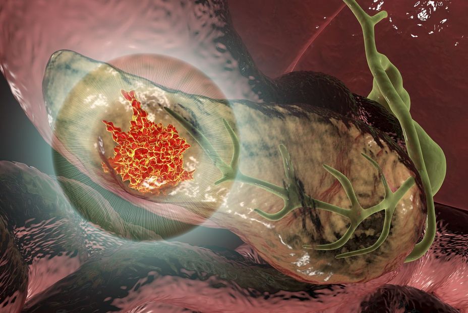 Imagen de un cáncer de páncreas. (Bigstock) Imagen de un cáncer de páncreas. (Bigstock)