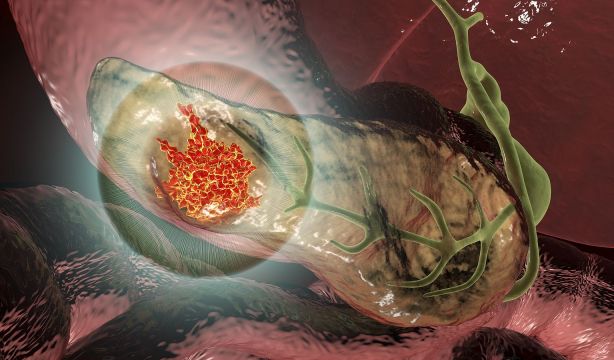 Golpe al cáncer de páncreas: logran eliminar por completo el tumor en ratones con una triple terapia