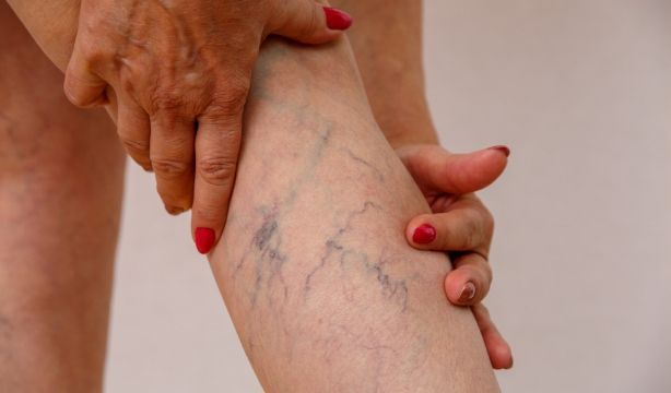 Hablando en plata: varices