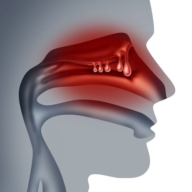 poliposis nasal