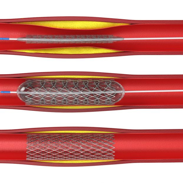 Procedimiento en la angioplastia Procedimiento en la angioplastia