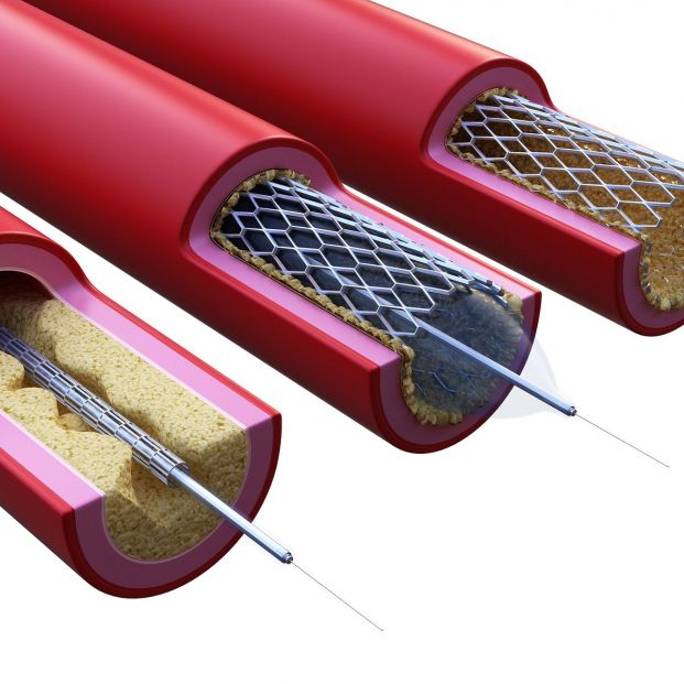 Stent en angioplastia