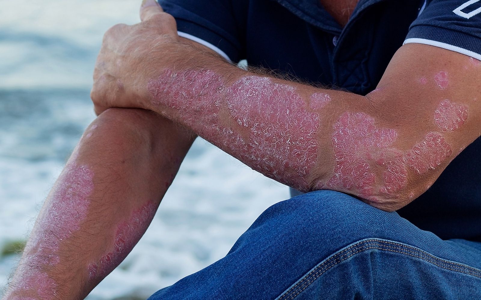 Un 90% de los adultos con dermatitis atópica grave sufre trastornos del sueño, (Bigstock)