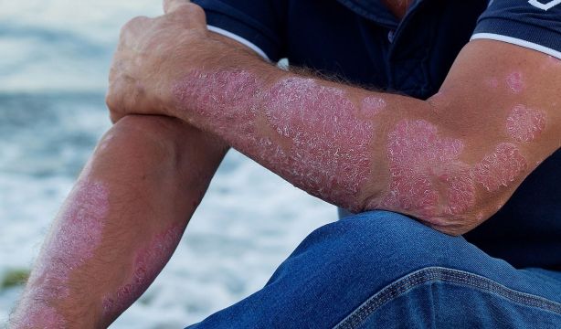 Un 90% de los adultos con dermatitis atópica grave sufre trastornos del sueño, (Bigstock)