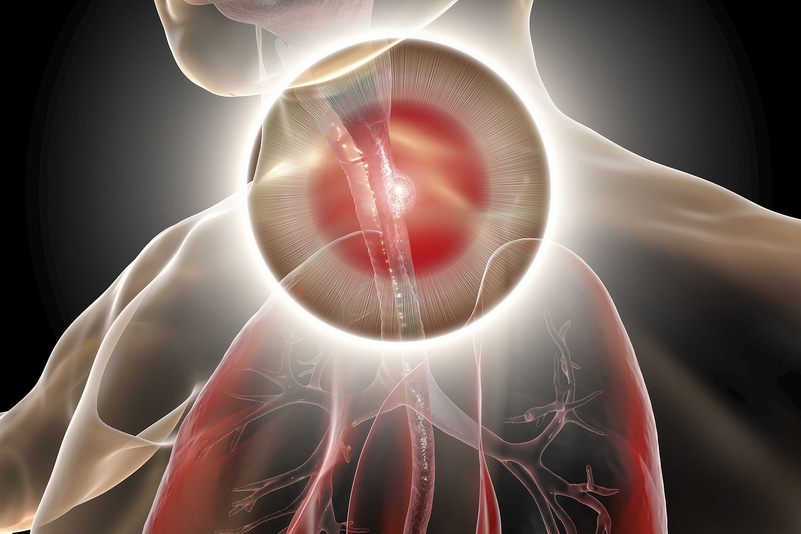 La gripe y los resfriados agravan las complicaciones en pacientes con dificultades para tragar. Foto: Bigstock.