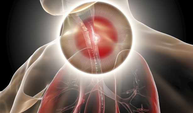 La gripe y los resfriados agravan las complicaciones en pacientes con dificultades para tragar. Foto: Bigstock.