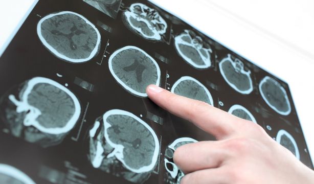 Cribados selectivos, la apuesta de los investigadores para personas con riesgo de alzhéimer
