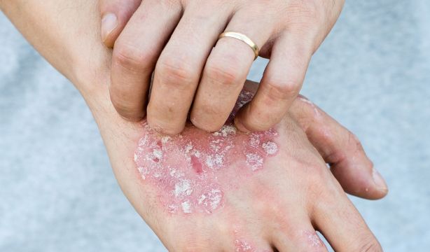 Llega una nueva y prometedora terapia oral para la psoriasis. (Bigstock)
