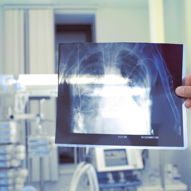 silicosis silicosis