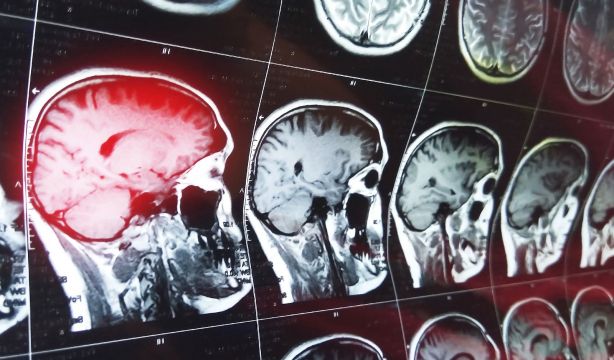Cáncer de mama avanzado: la supervivencia depende del momento de las metástasis cerebrales
