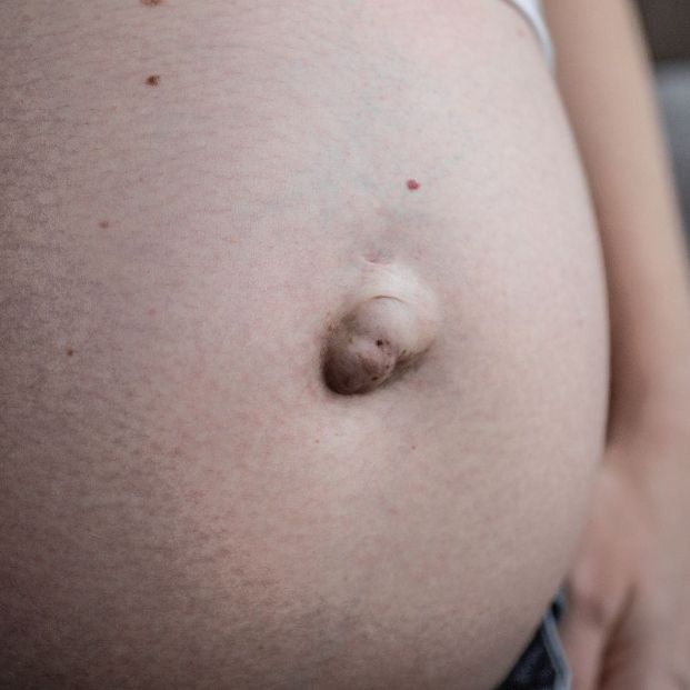 Hernia umbilical Hernia umbilical