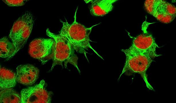 Nanotecnología y terapia celular se unen para atacar el neuroblastoma infantil. Foto: Europa Press.