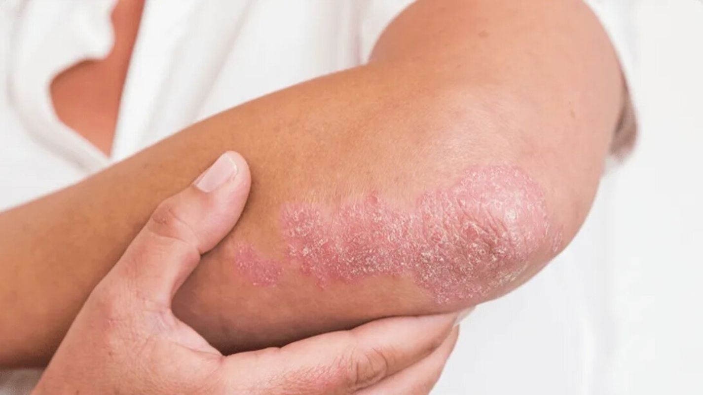 El potencial de fármacos activados por luz contra la psoriasis. Fuente: Europa Press.