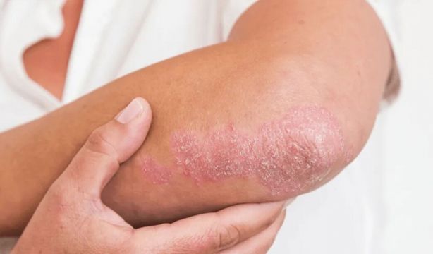 El potencial de fármacos activados por luz contra la psoriasis. Fuente: Europa Press.