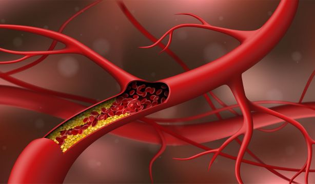 Desarrollan un fármaco oral que reduce los niveles elevados de grasa en sangre. Foto: Bigstock.
