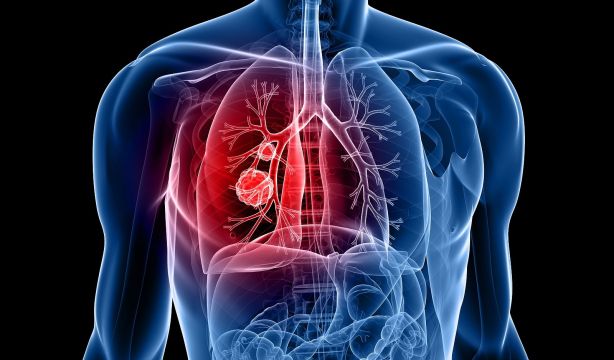 Un estudio confirma que la exposición a partículas finas aumenta el riesgo de cáncer de pulmón