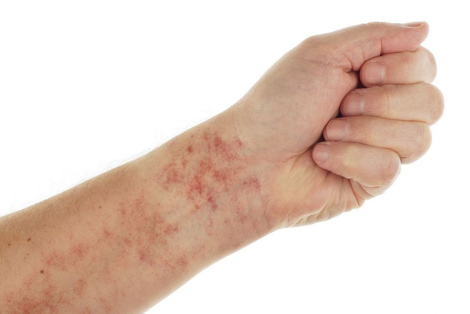 Medicamentos y cosméticos pueden influir en ciertas reacciones con el sol