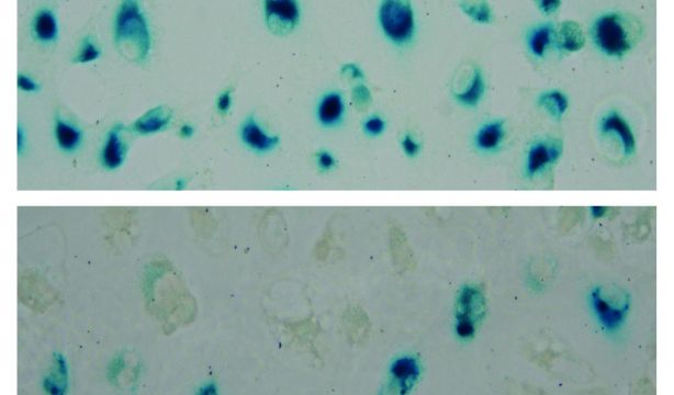 Un compuesto derivado de la anémona del mar Caribe podría mejorar el tratamiento contra el cáncer
