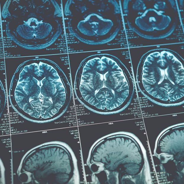 Hito histórico en alzhéimer: revierten los síntomas con ultrasonidos en una paciente china. (Bigstock)