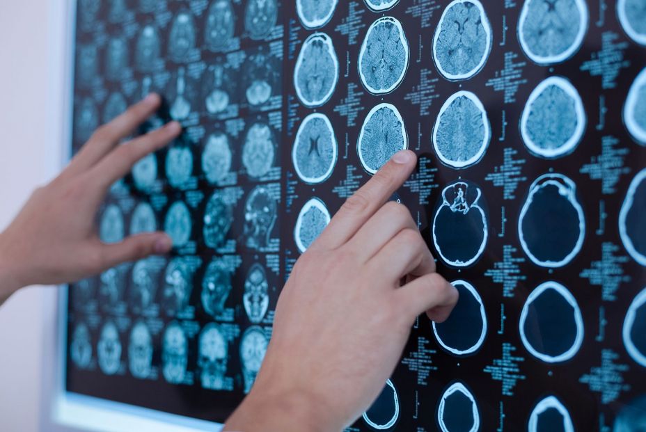 Alzheimer: los fármacos que eliminan placas no mejoran la enfermedad, según un estudio