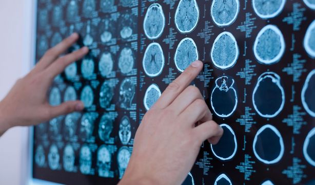 Alzheimer: los fármacos que eliminan placas no mejoran la enfermedad, según un estudio