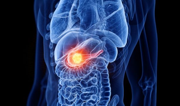La resistencia a la insulina medida por IA encuentra vínculos con 12 tipos de cáncer