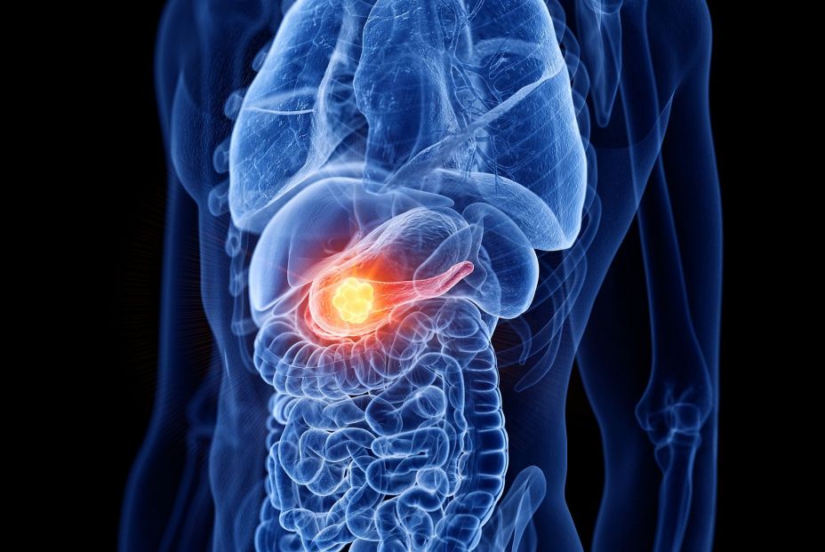 Un estudio identifica un tratamiento que duplica la supervivencia en cáncer de páncreas avanzado Un estudio identifica un tratamiento que duplica la supervivencia en cáncer de páncreas avanzado