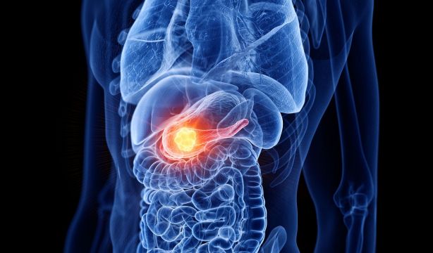 Avance en el cáncer de páncreas: una nueva estrategia ataca las células tumoralesestudio identifica un tratamiento que duplica la supervivencia en cáncer de páncreas avanzado