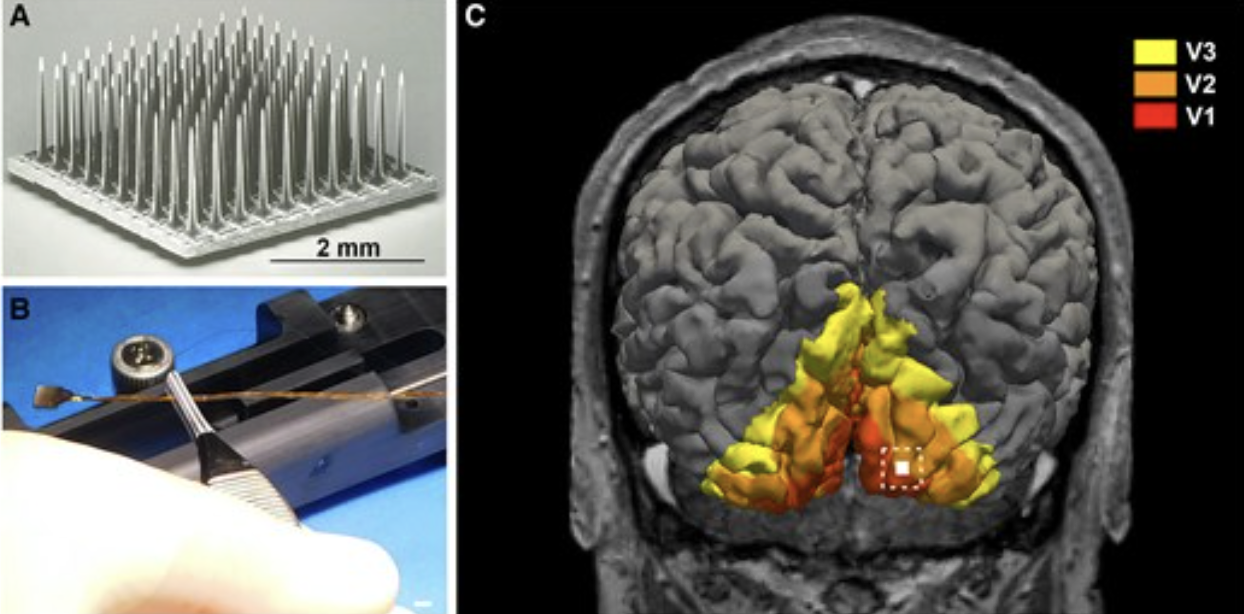 Un hombre ciego recupera la visión gracias a un implante en el cerebro