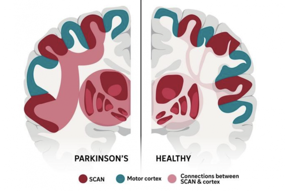 Identifican red cerebral responsable de la enfermedad de párkinson