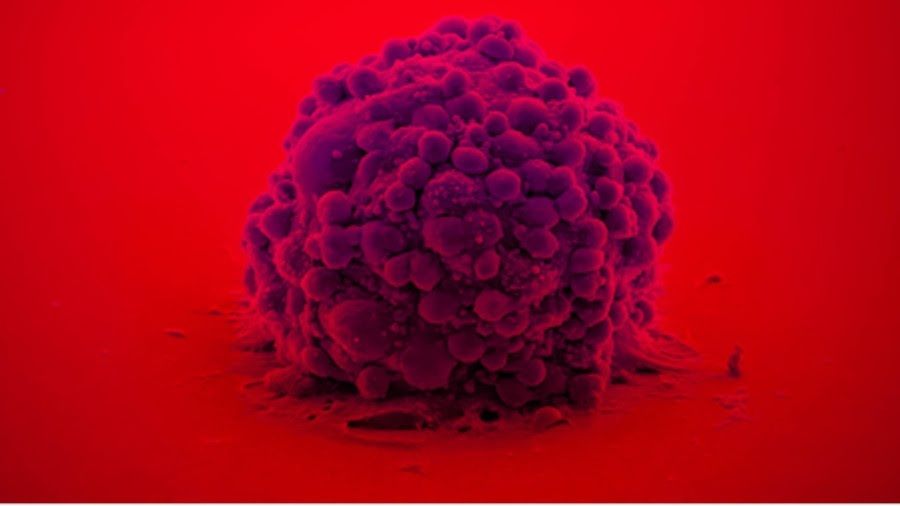 Desarrollan un bioadhesivo inspirado en mejillones que elimina células del tumor cerebral más letal