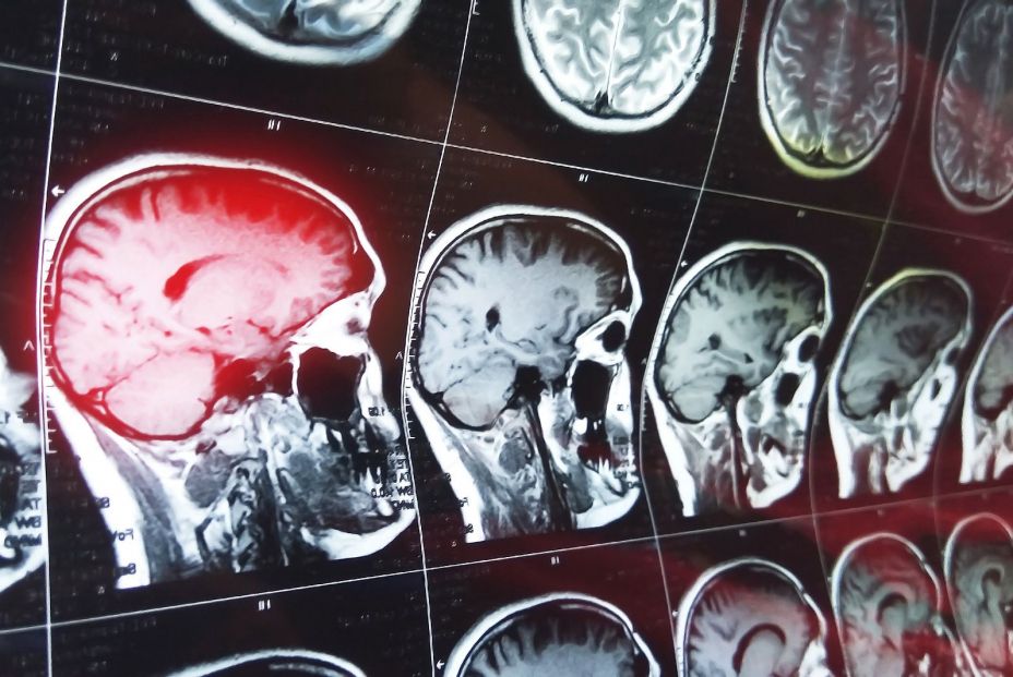 Descubren cómo el cerebro se protege frente a la depresión