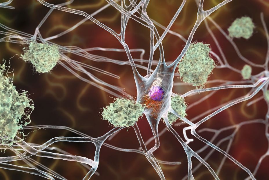 Neuronas de la enfermedad de alzhéimer. (BIgstock). 