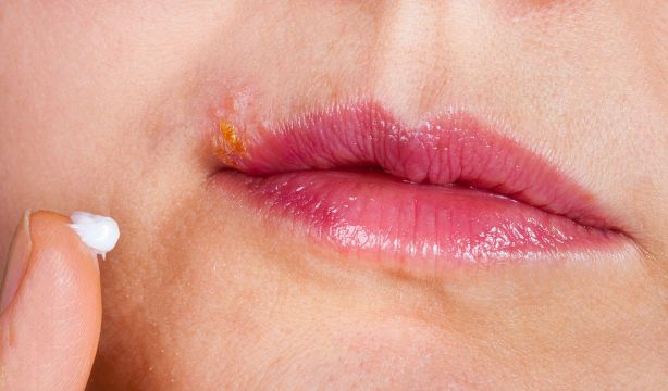 El virus del herpes labial puede provocar cambios similares al alzhéimer en neuronas humanas