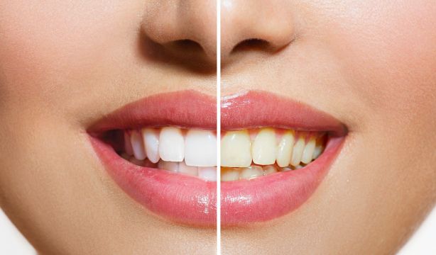 El peligro oculto de los trucos virales para blanquear los dientes. Foto: Bigstock.