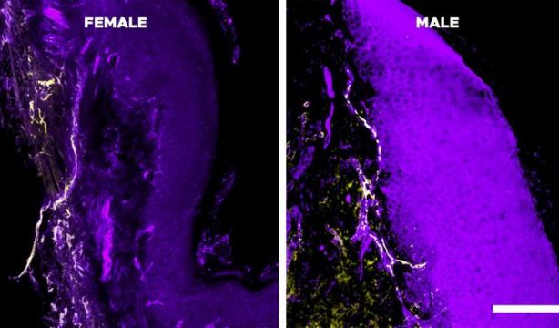 niveles más bajos de la subunidad del receptor de IL-10, en amarillo, en células cutáneas femeninas (izquierda) que en células masculinas (derecha). Laboratorio Laumet.