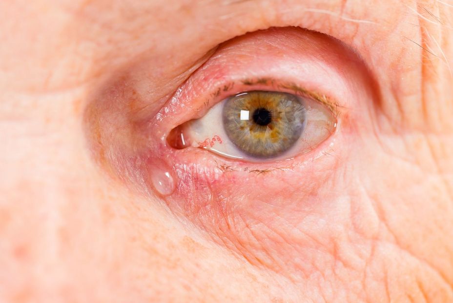 Un paciente de alzhéimer llorando. (Bigstock)