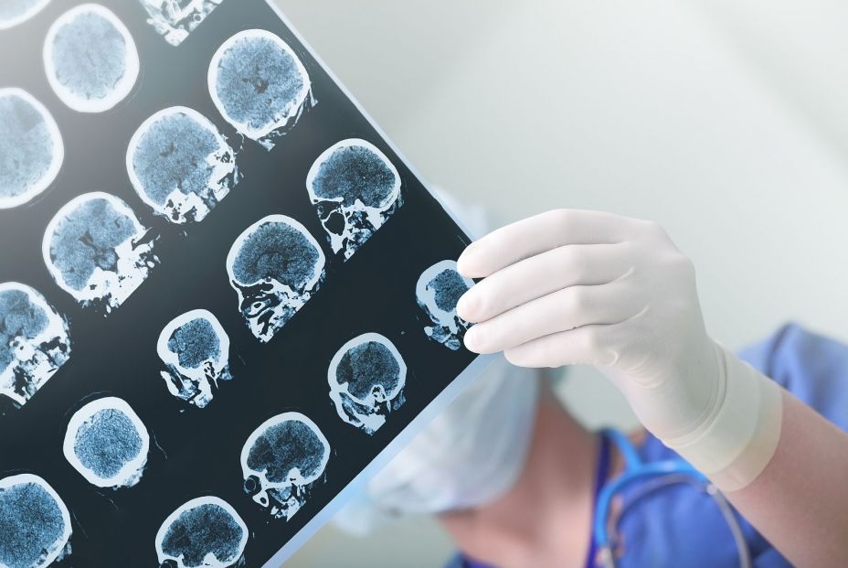 Un médico analizando una prueba de imagen del cerebro de un paciente. (Bigstock)