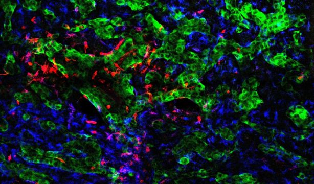 Un hallazgo del CNIO revela cómo el cerebro es reprogramado para favorecer la metástasis. Foto: Europa Press.