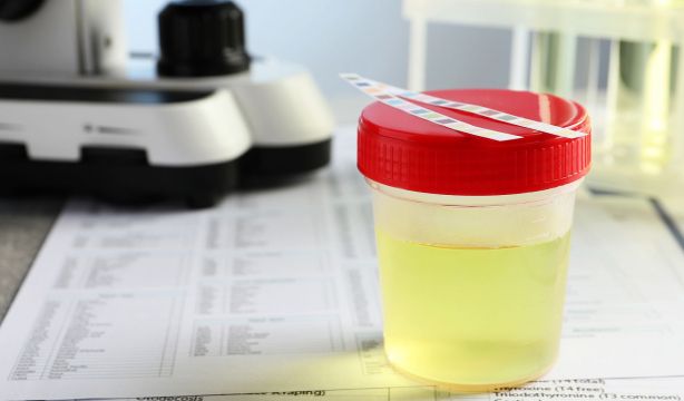 Una prueba de orina permite saber en horas qué antibiótico tomar para la infección urinaria. Fuente: BigStock.
