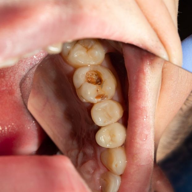 Absceso dental Absceso dental