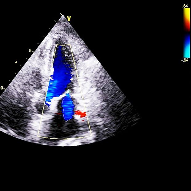 65 años valvulopatía ecocardiografía