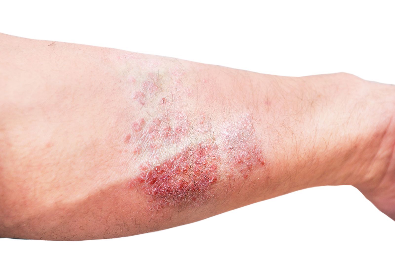 eczema en adultos