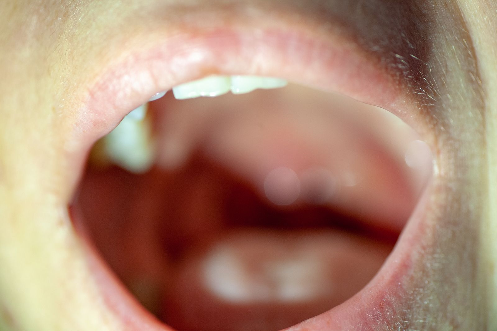 Sintomas del cáncer de laringe