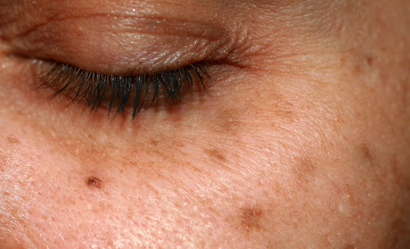 Especialistas dermatólogos alertan de la mala salud de la piel de las personas mayores