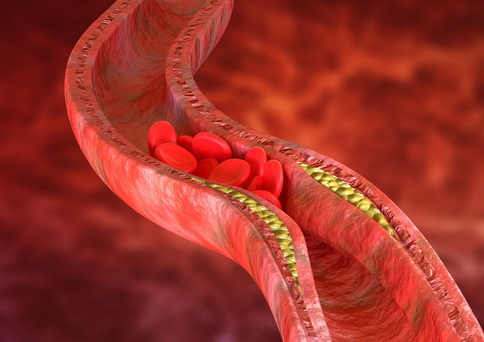 Arterioesclerosis