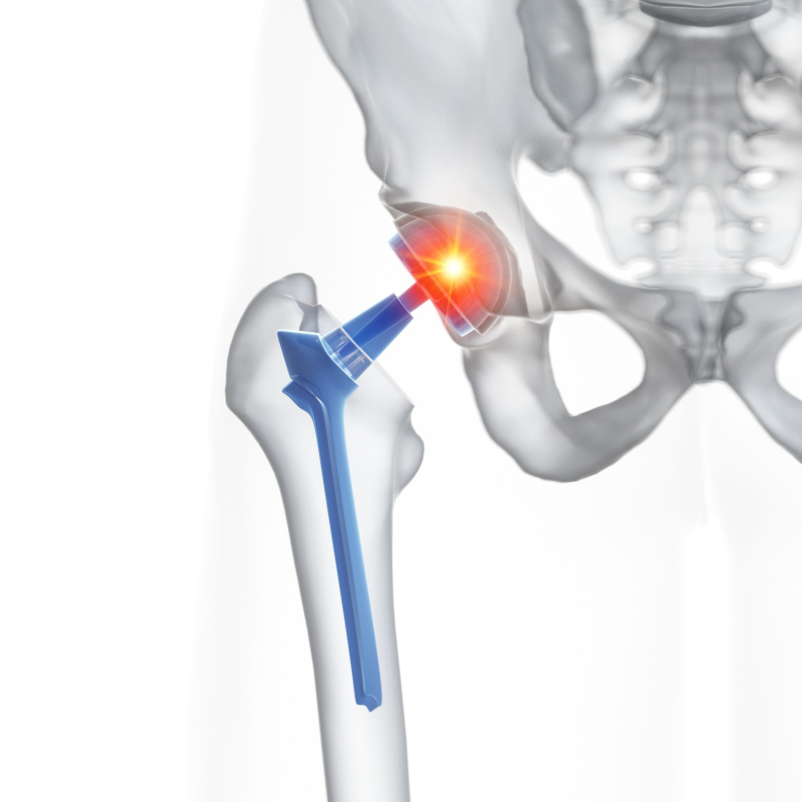 Cómo ayuda la fisioterapia tras una operación de prótesis de cadera (Bigstock)
